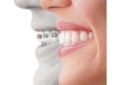 Invisalign Invisible Braces in Sydney