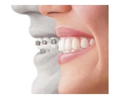 Invisalign Invisible Braces in Sydney