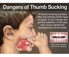Learn How To Break The Habit Of Thumb Or Finger Sucking from Banksia Grove Dentist