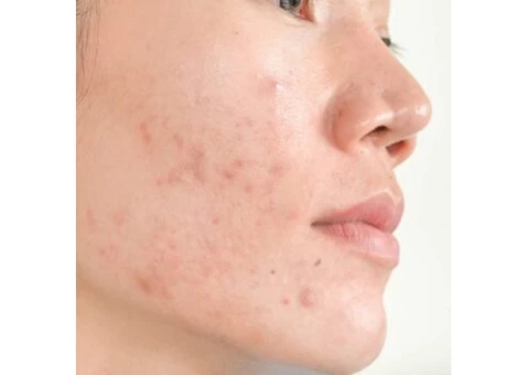 Types of Acne And Best Method To Treat Them from the Top Health and Skin Care Experts Australia!