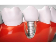 Revamp Your Look With State-Of-The-Art Dental Implants In NSW!