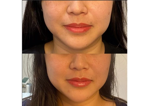 Best Quality Lip Tattoo in Drummoyne by IPSN Certified Aestheticians