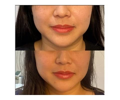 Best Quality Lip Tattoo in Drummoyne by IPSN Certified Aestheticians