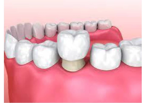 From Damaged Teeth to Dazzling: Get Your Dental Crown Treatment!
