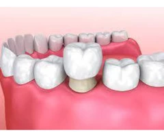 From Damaged Teeth to Dazzling: Get Your Dental Crown Treatment!