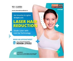 Laser Hair Removal Treatment in hyderabad