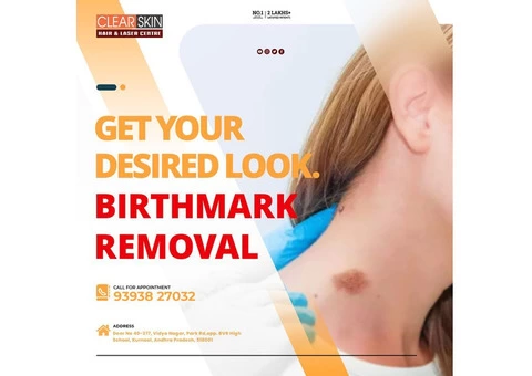 best Birthmark removal laser treatment in hyderabad