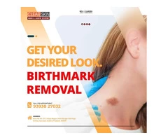 best Birthmark removal laser treatment in hyderabad
