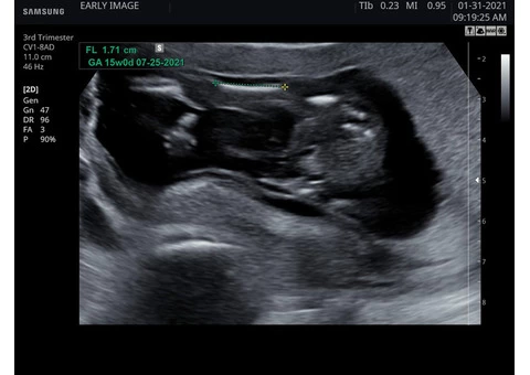 Trust Early Image for Safe, Accurate, and Non-Invasive Gender Scan Determination