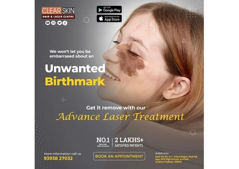 Laser Treatment For Birthmark Removal In Andhra Pradesh AP