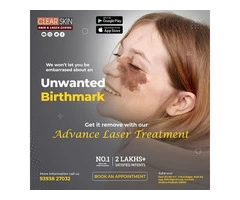 Laser Treatment For Birthmark Removal In Andhra Pradesh AP