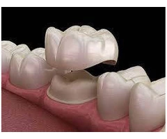 Dental Crowns and Bridges: Your Solution for damaged teeth