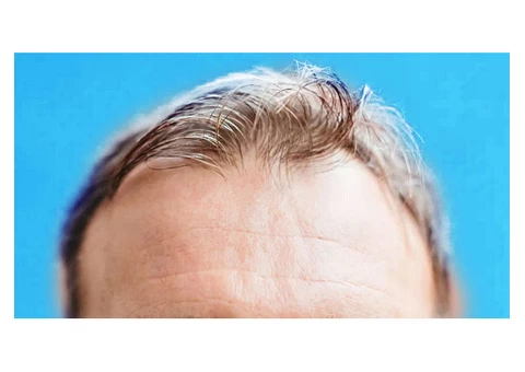 Learn the Side Effects on Hair Regrowth Treatment from the Experts of Hair Transplant Australia