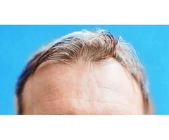 Learn the Side Effects on Hair Regrowth Treatment from the Experts of Hair Transplant Australia
