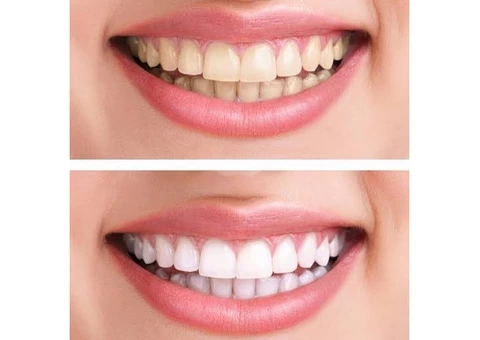 Invisalign Clear Aligners in Dural