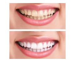 Invisalign Clear Aligners in Dural
