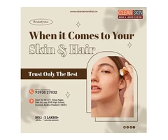 best advanced acne laser treatment in bangalore