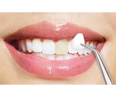 Looking to enhance your smile's appearance? Dental Veneers are a great option!