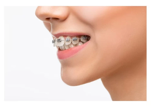 Sydney's Best Invisible Braces Clinics: How to Choose the Right One for You