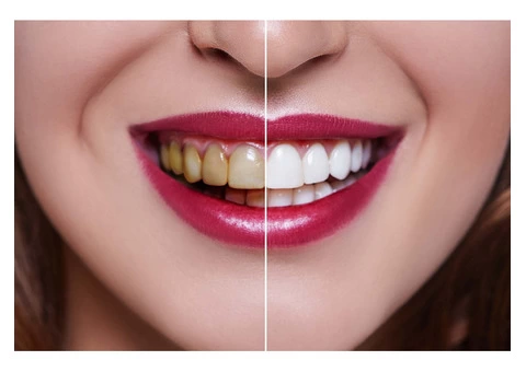 Transform your smile with expert teeth whitening services