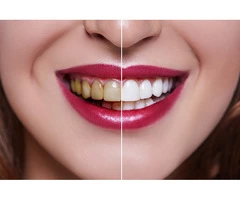 Transform your smile with expert teeth whitening services