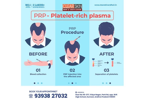 PRP hair Treatment in bangalore