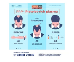 PRP hair Treatment in bangalore