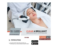 best vascular laser treatment in hyderabad