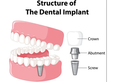 Understanding The Dental Implant Treatment Procedure & Cost