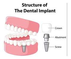 Understanding The Dental Implant Treatment Procedure & Cost