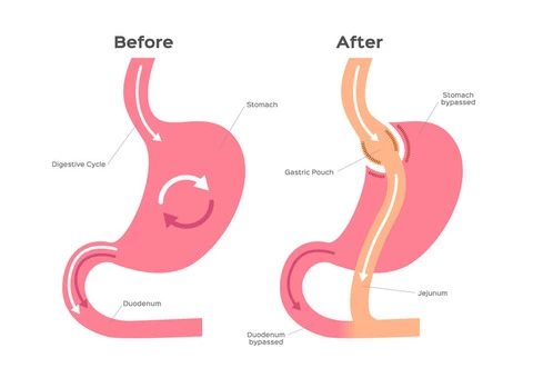 Transforming Your Journey To Weight Loss: Exploring Gastric Bypass