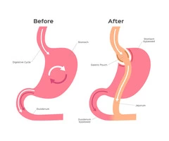 Transforming Your Journey To Weight Loss: Exploring Gastric Bypass