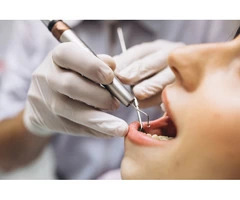 Opt For Tooth Extraction in Melbourne