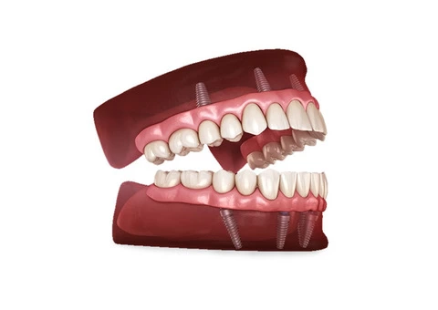 Implant Supported Overdentures | Springvale Dental Clinic