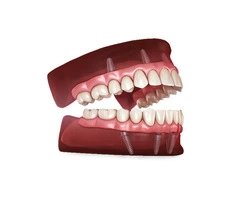 Implant Supported Overdentures | Springvale Dental Clinic