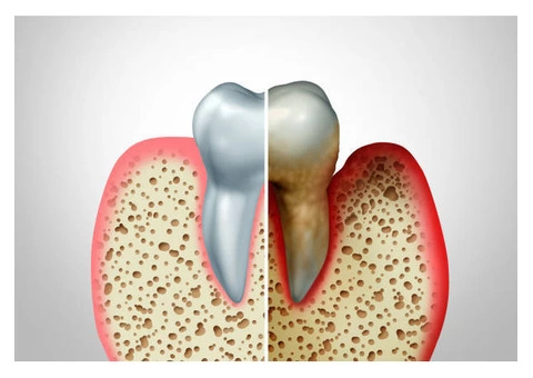 Effective Gum Disease Treatment in Melbourne for Healthy Smiles