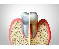 Effective Gum Disease Treatment in Melbourne for Healthy Smiles