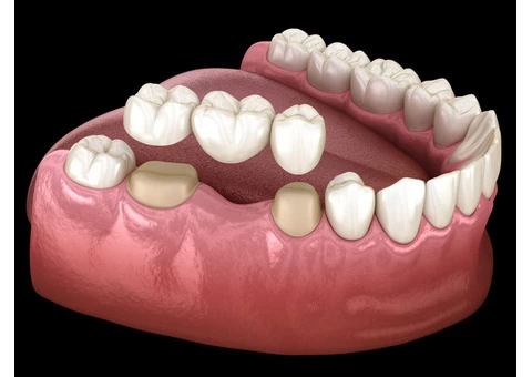 Reclaim Your Smile with Dental Crowns & Bridges!