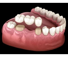 Reclaim Your Smile with Dental Crowns & Bridges!