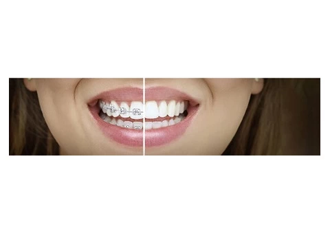 Discover Invisalign consultation in Baulkham Hills: Transform Your Smile!