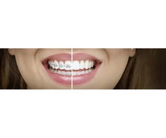 Discover Invisalign consultation in Baulkham Hills: Transform Your Smile!