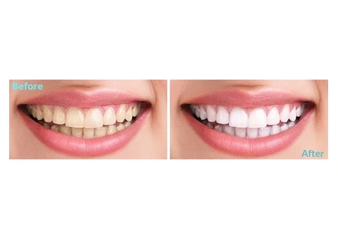 Best Teeth Whitening Treatment Baulkham Hills