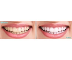 Best Teeth Whitening Treatment Baulkham Hills