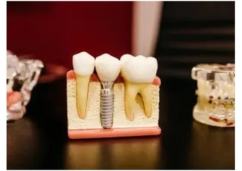 Cheap Dental Implants Australia - Dental Costs Australia - 1/4
