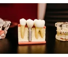Cheap Dental Implants Australia - Dental Costs Australia