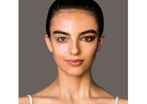 Melasma Treatment Melbourne