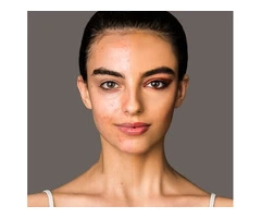 Melasma Treatment Melbourne