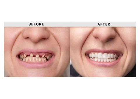 Unlocking Your Brightest Smile: The Magic of Porcelain Dental Veneers