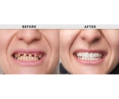 Unlocking Your Brightest Smile: The Magic of Porcelain Dental Veneers