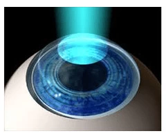 Experience Superior Vision Correction with Melbourne's Best PRK Surgeon